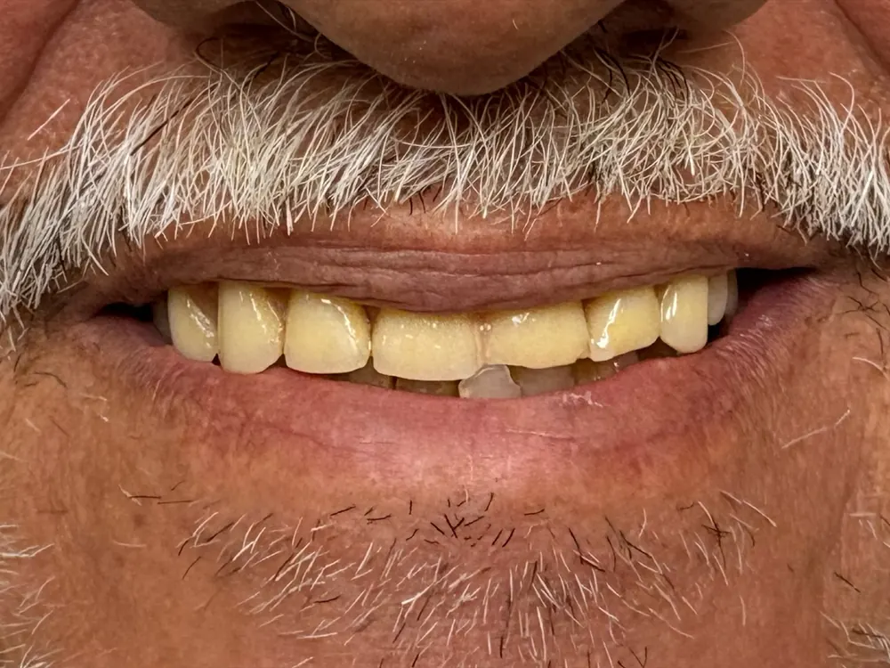 Reconstituição do sorriso — antes